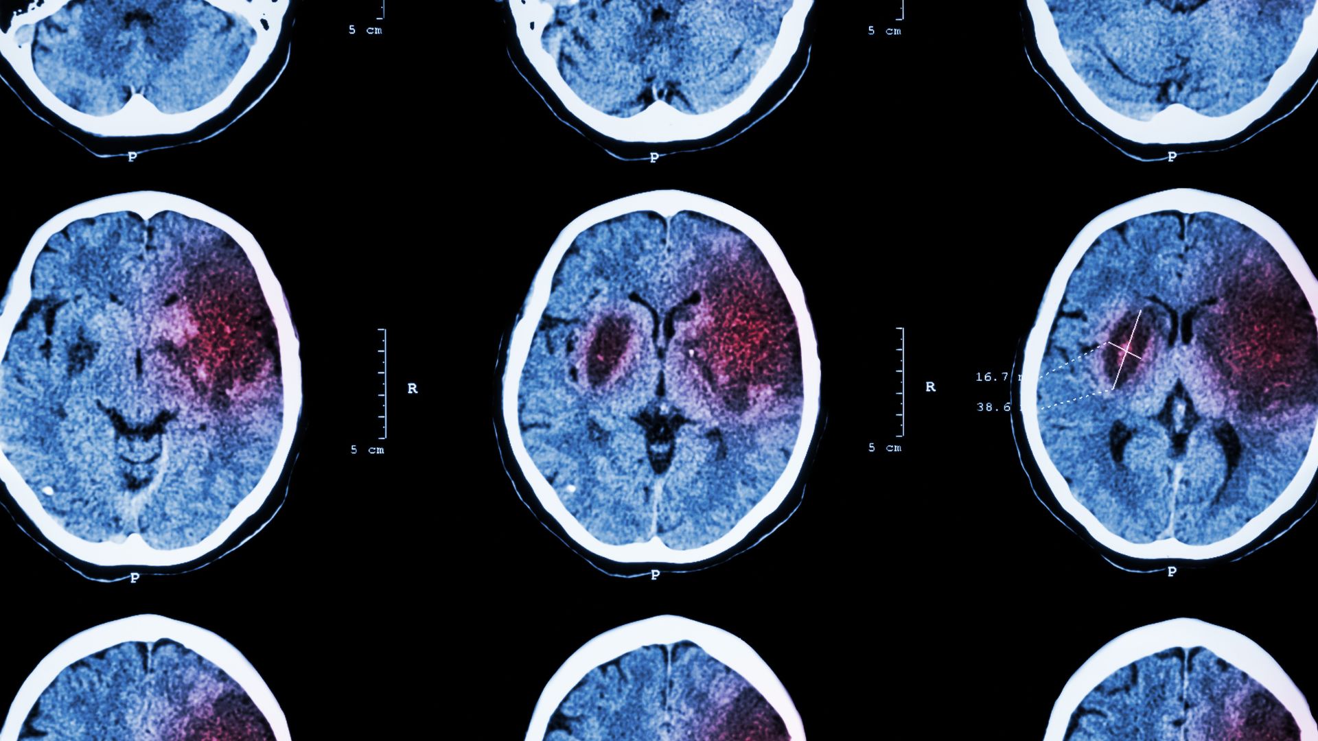 riabilitazione post-ictus