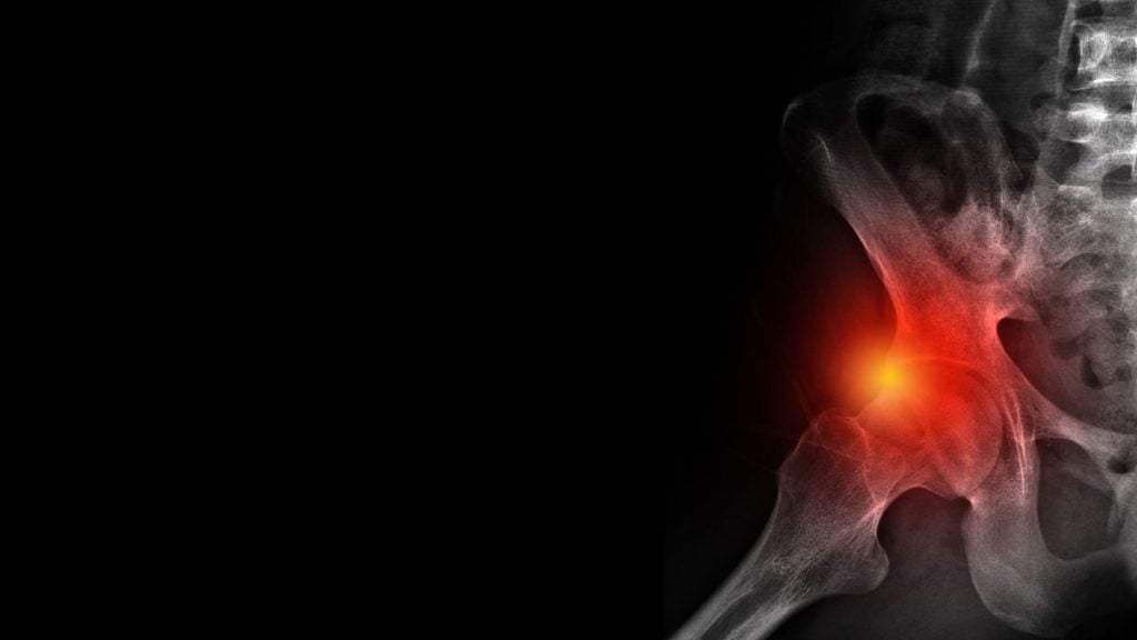 femural acetabolar impingement