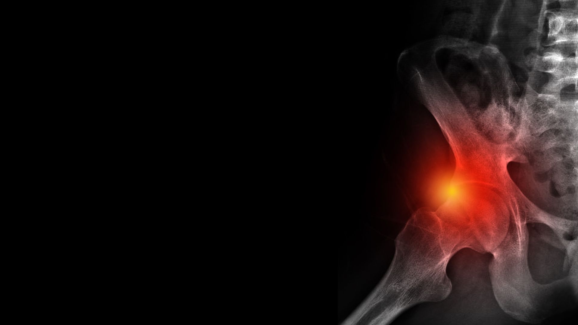 femural acetabolar impingement