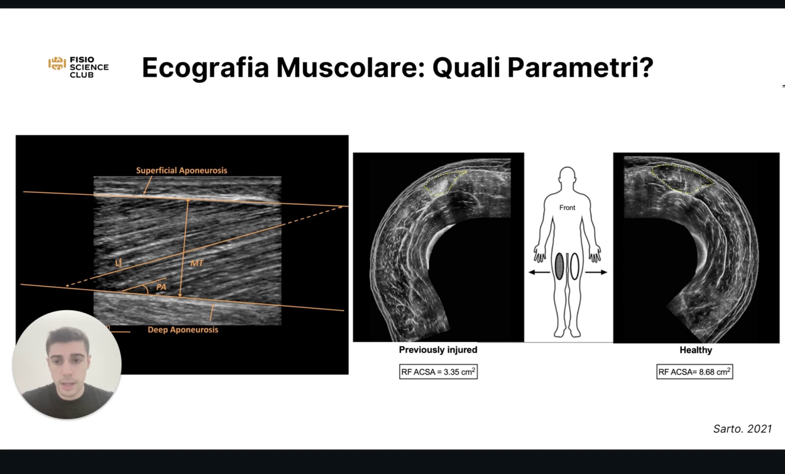 Anatomia ecografica: ginocchio e complesso degli hamstring