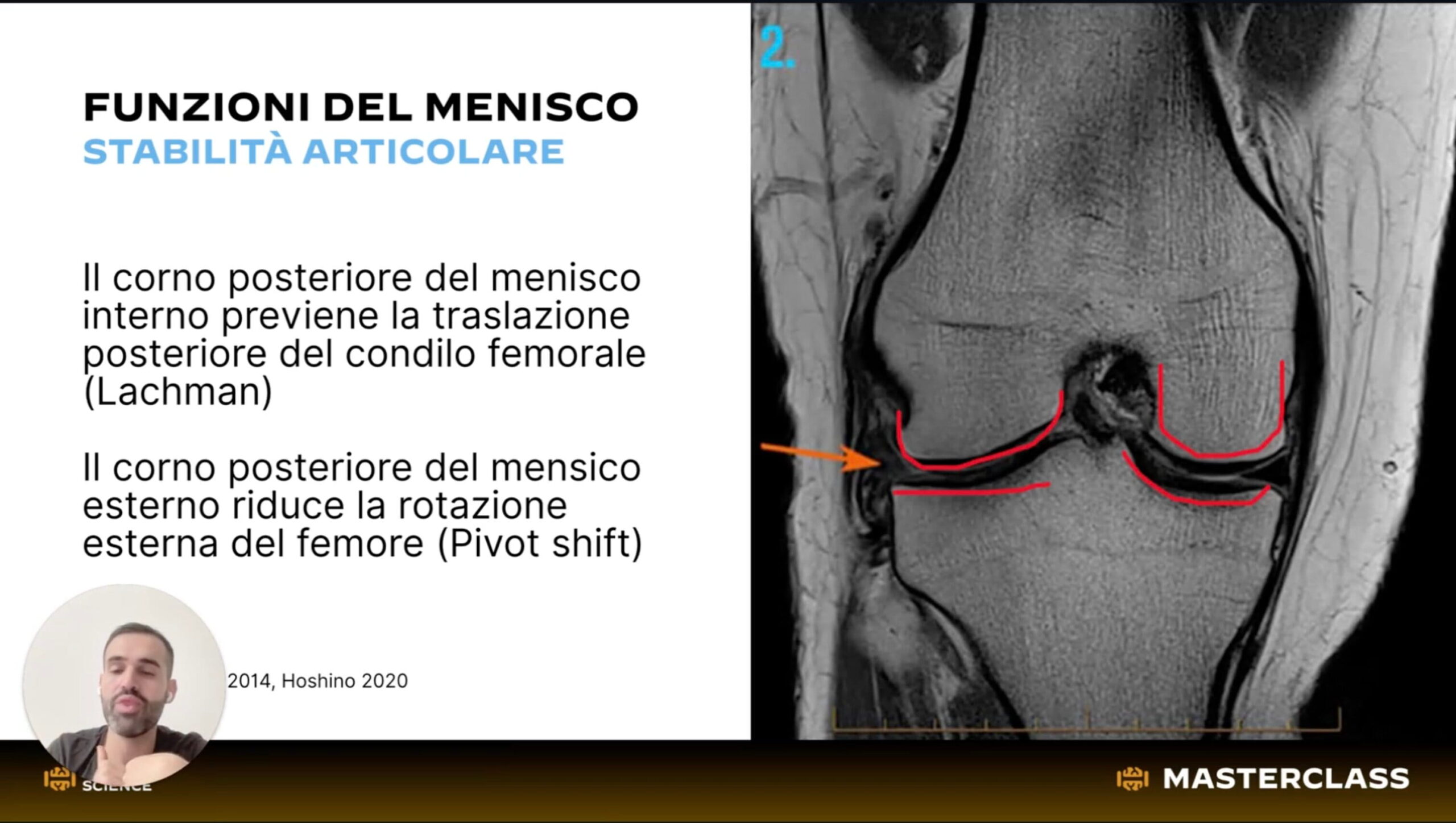 Lesioni Meniscali